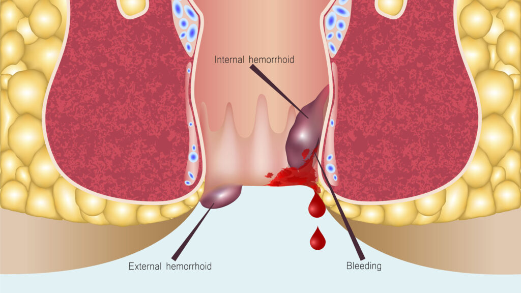 Hemorrhoids During Pregnancy | What are Hemorrhoids?